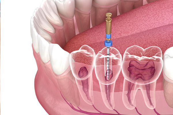 اندو یا درمان ریشه دندان
