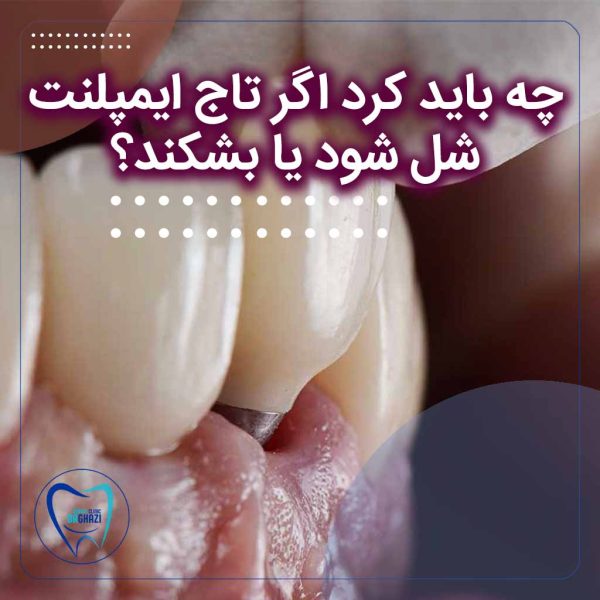 رفع مشکلات تاج ایمپلنت در دندانپزشکی سعادت آباد