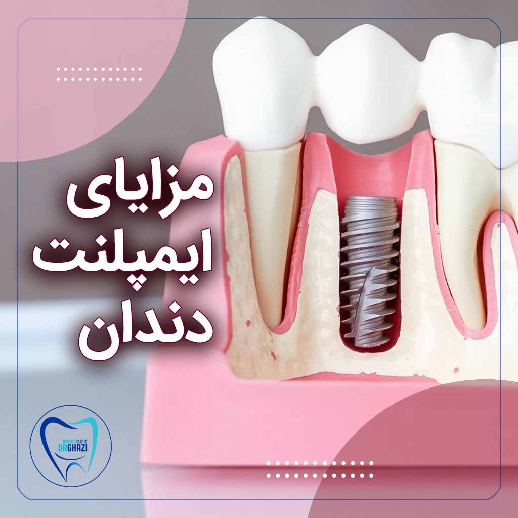 ایمپلنت دندان در سعادت آباد