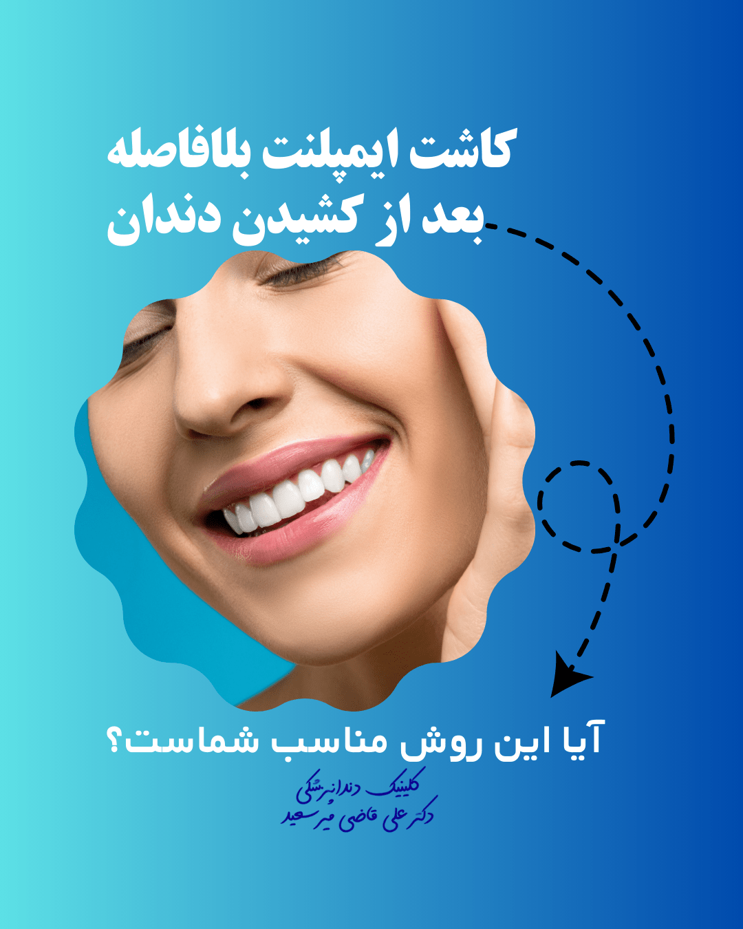 ایمپلنت دندان در سعادت آباد