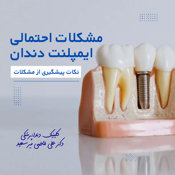 مشکلات احتمالی ایمپلنت دندان