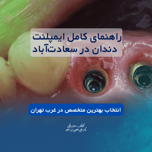 راهنمای کامل ایمپلنت دندان در سعادت‌آباد | انتخاب بهترین متخصص ایمپلنت در غرب تهران