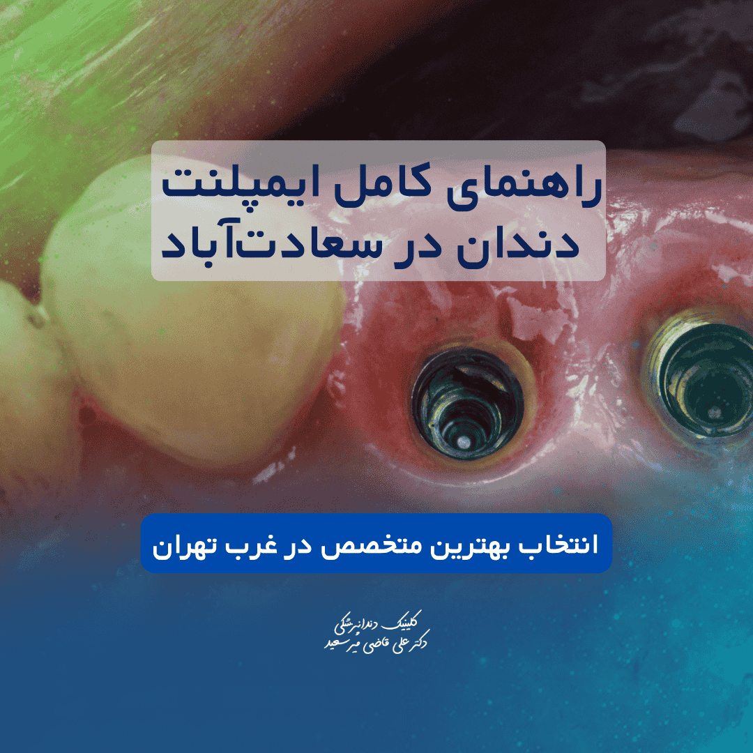 راهنمای کامل ایمپلنت دندان در سعادت‌آباد | انتخاب بهترین متخصص ایمپلنت در غرب تهران