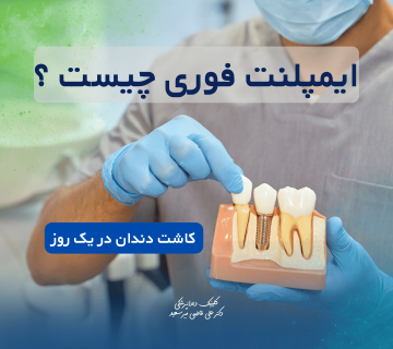 ایمپلنت فوری در سعادت‌آباد | کاشت دندان در یک روز بدون درد