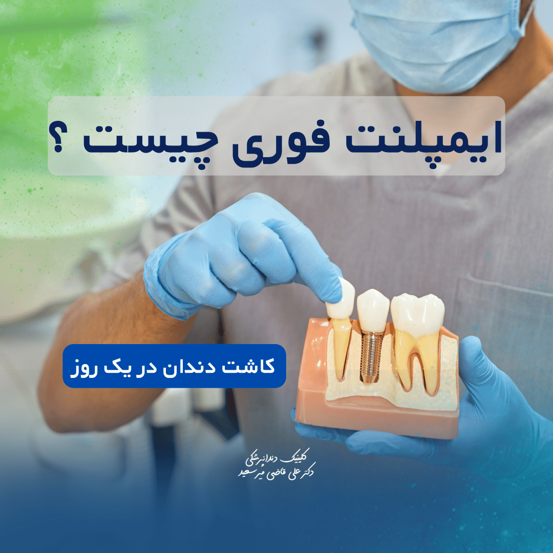 ایمپلنت فوری در سعادت‌آباد | کاشت دندان در یک روز بدون درد