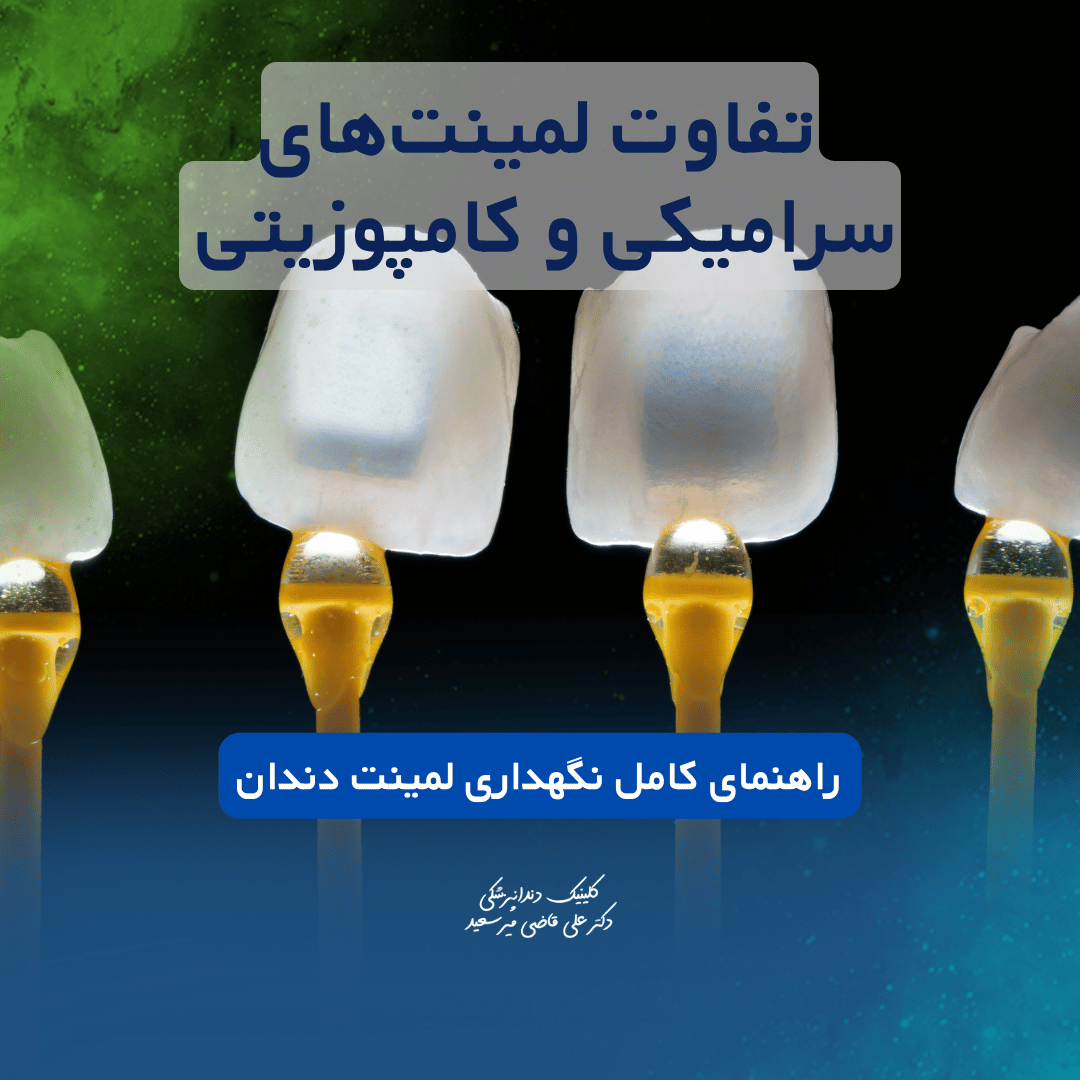 تفاوت لمینت سرامیکی و کامپوزیتی