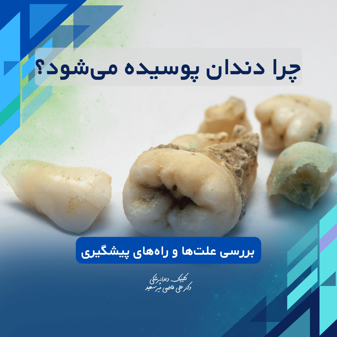 چرا دندان پوسیده میشود؟