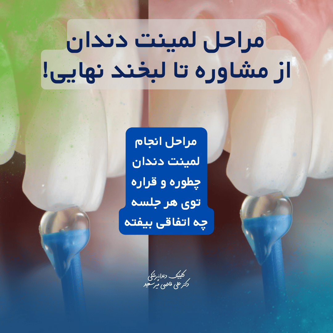 مراحل انجام لمینت دندان