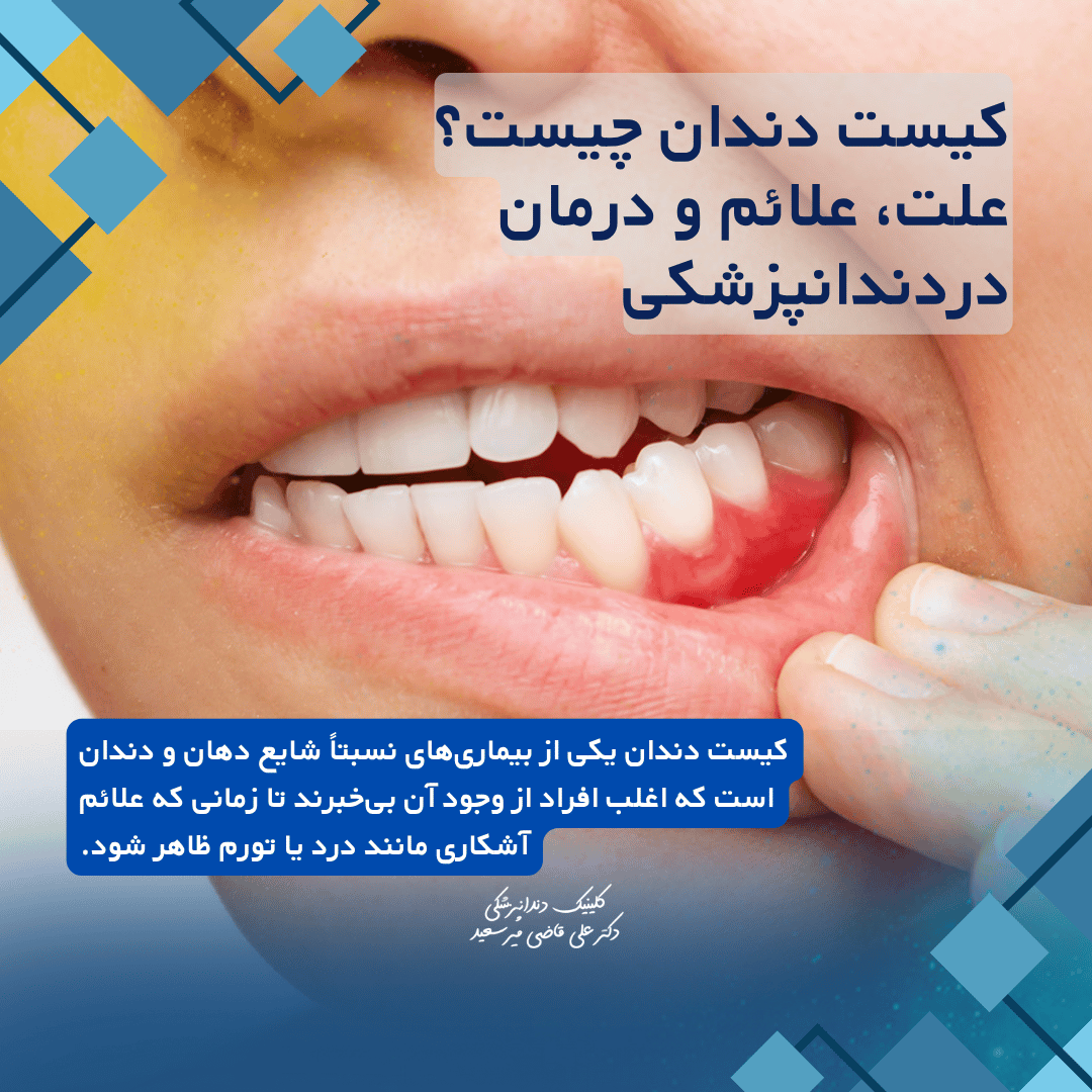 کیست دندان
