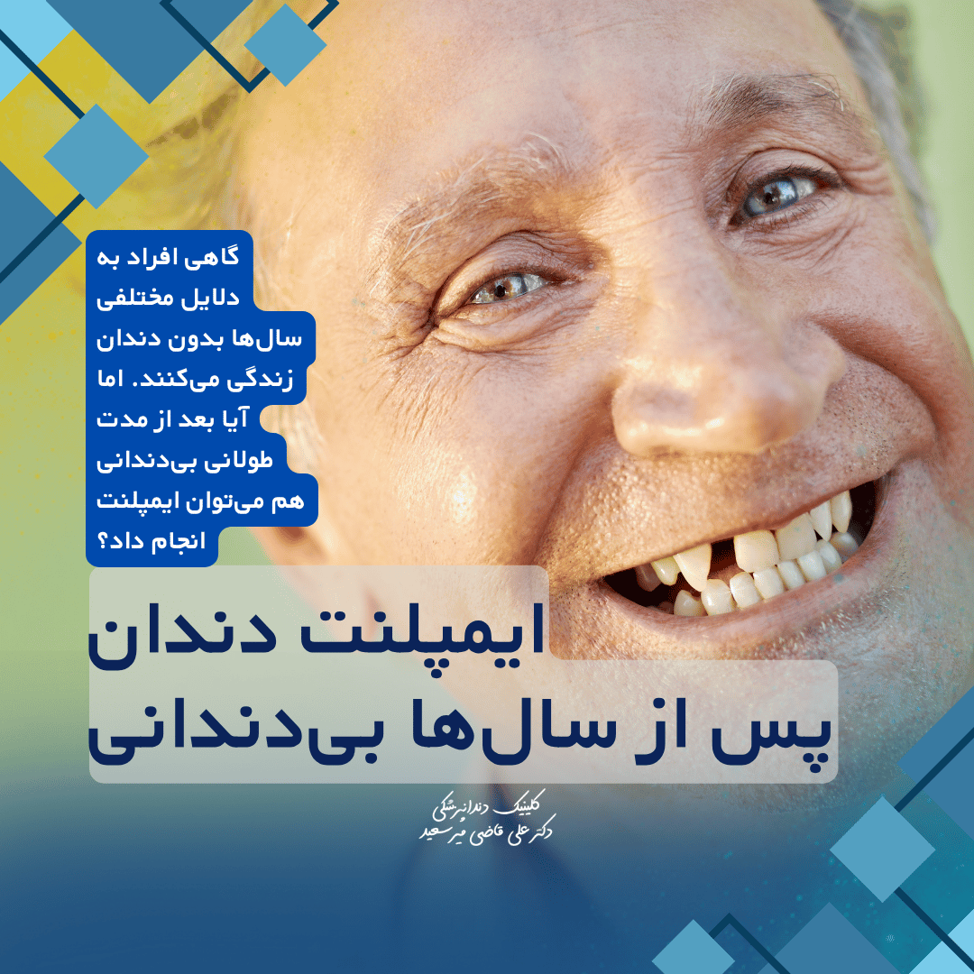 ایمپلنت دندان پس از بی‌دندانی طولانی