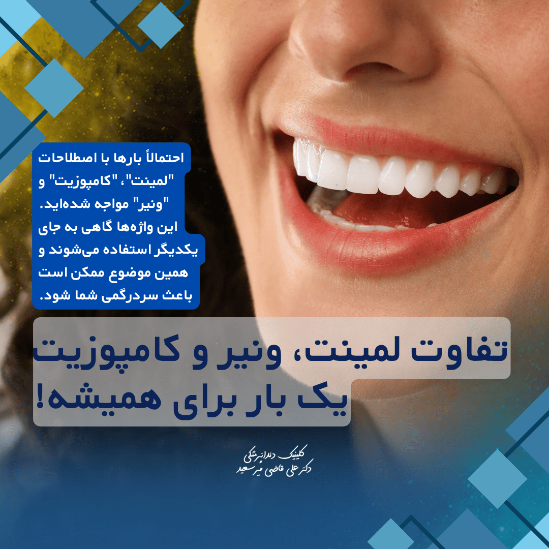 تفاوت لمینت، ونیر و کامپوزیت؛ یک بار برای همیشه!
