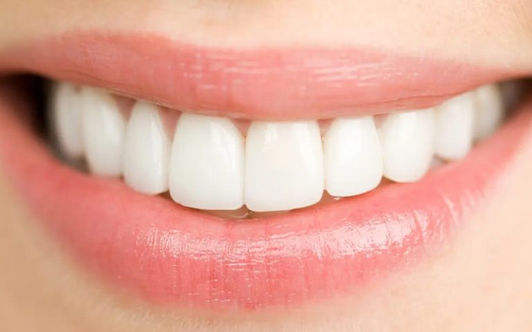 لمینت دندان خرگوشی چیست؟