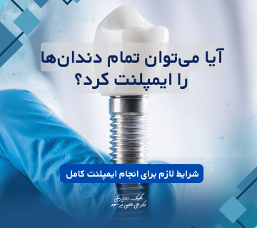 ایمپلنت کامل دندان