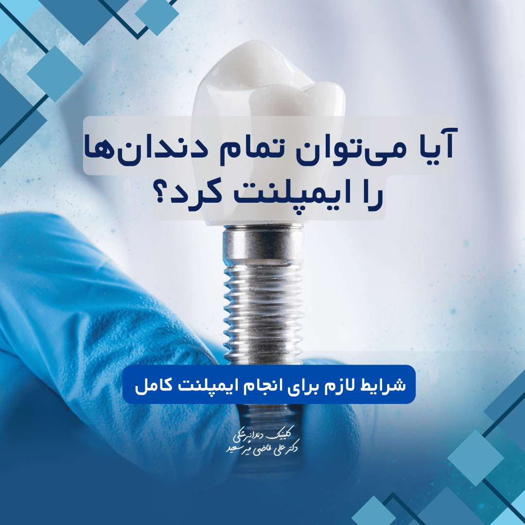 ایمپلنت کامل دندان