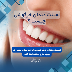 لمینت دندان خرگوشی چیست؟