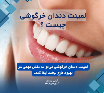 لمینت دندان خرگوشی چیست؟