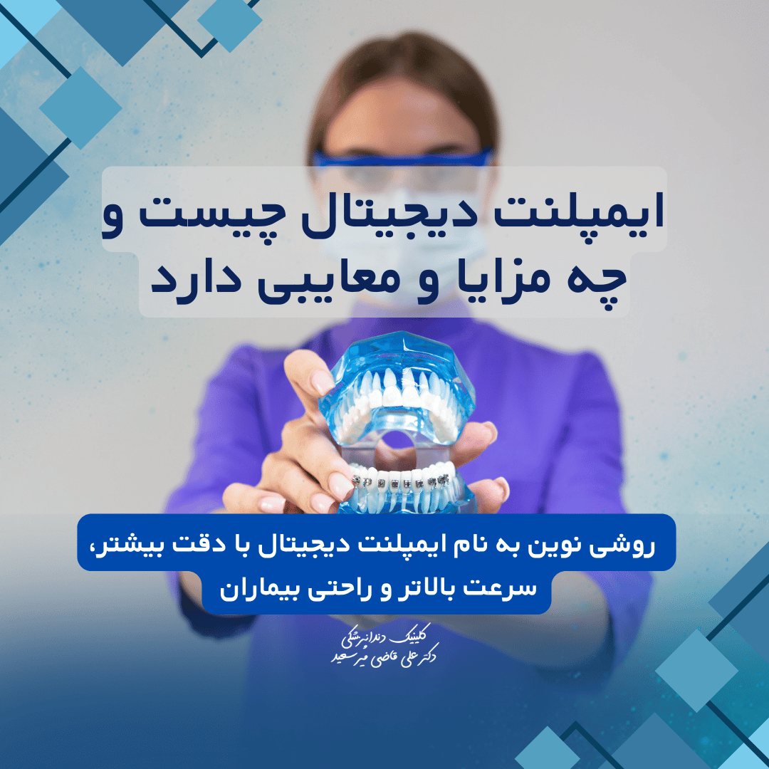 ایمپلنت دیجیتال چیست و چه مزایا و معایبی دارد + قیمت در سال ۱۴۰۴