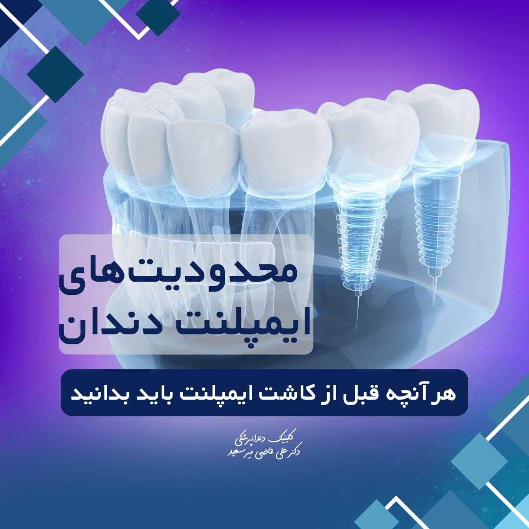 محدودیت‌های ایمپلنت دندان