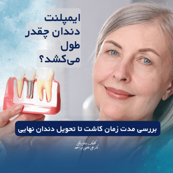 ایمپلنت دندان چقدر طول می‌کشد؟
