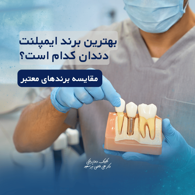 بهترین برند ایمپلنت دندان کدام است؟