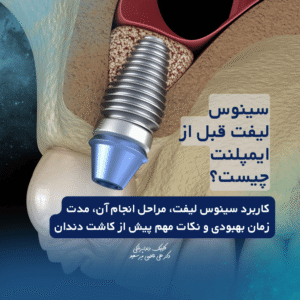 سینوس لیفت قبل از ایمپلنت چیست؟