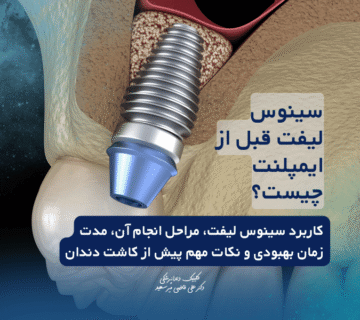 سینوس لیفت قبل از ایمپلنت چیست؟