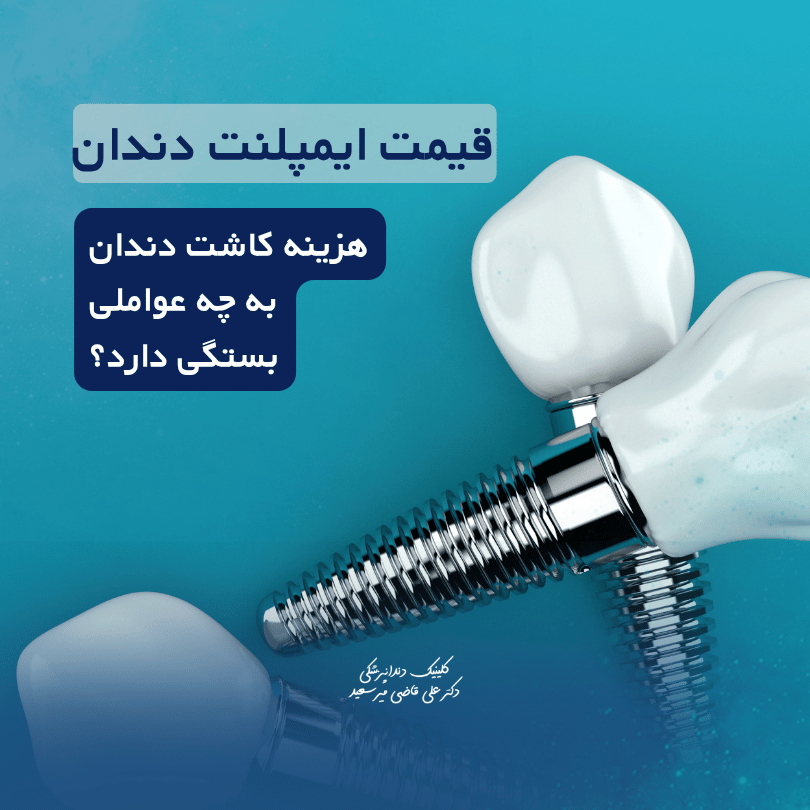 قیمت ایمپلنت دندان سعادت آباد