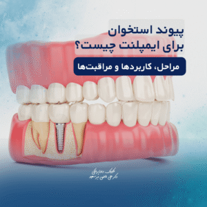 پیوند استخوان برای ایمپلنت
