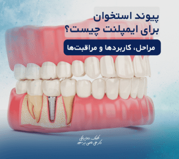 پیوند استخوان برای ایمپلنت