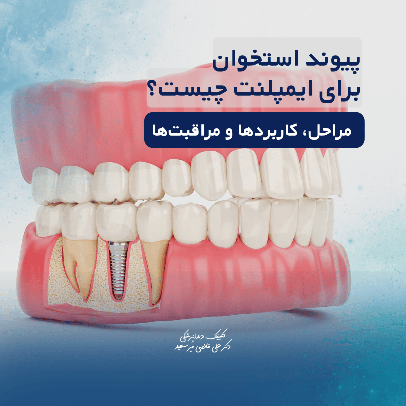 پیوند استخوان برای ایمپلنت